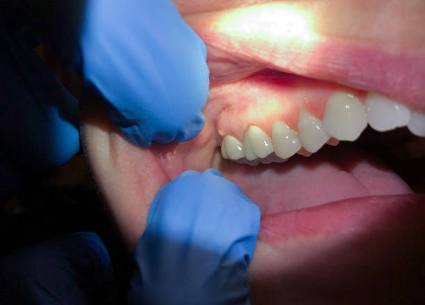 Best Emergency Dental Care for Abscessed Tooth in Doniphan, MO
